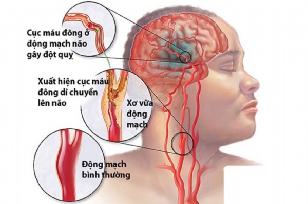 ​ Siêu Âm Doppler Động Mạch Cảnh – Bước Quan Trọng Trong Phòng Ngừa Đột Quỵ​ Não