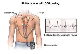 Holter điện tim