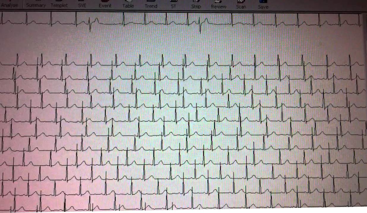 Holter điện tim